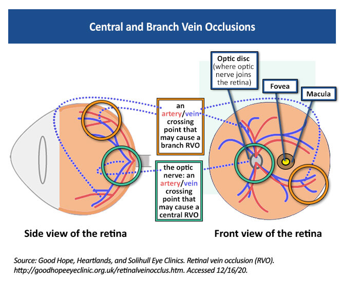 Retinal Vein Occlusion Disease Education