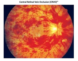 Retinal Vein Occlusion Symptoms: Disease Education: Vision RELIEF